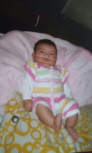 Baby Genesis before her surgeries