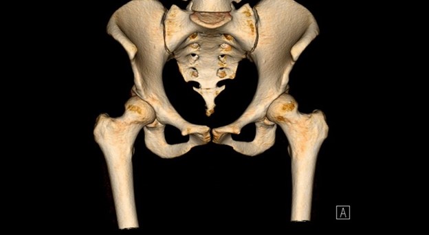 A digital scan of the hip area of a patient.