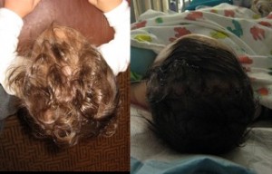 Grayson's head shape before (left) and after (right) surgery
