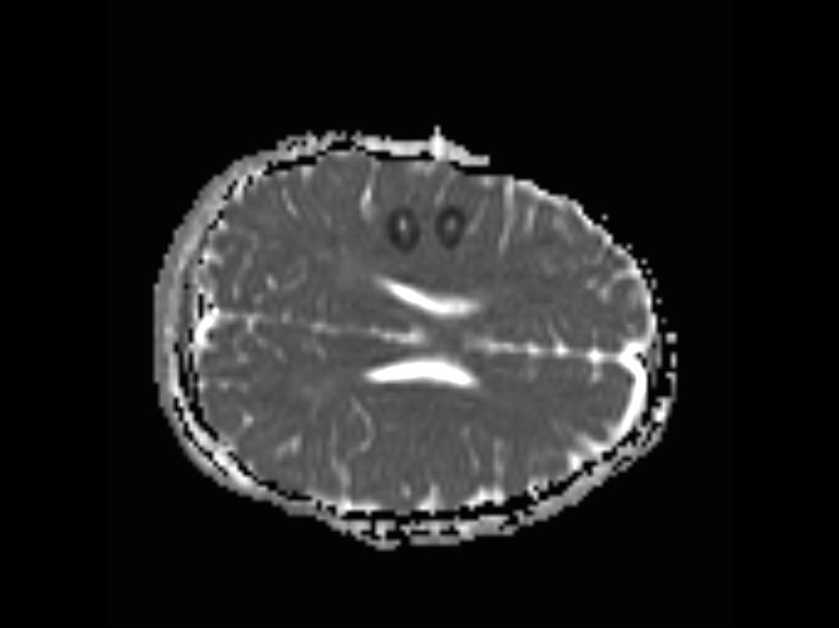 Laser ablation offered a minimally-invasive solution to stopping Giorgia's seizures. This scan taken at the time of her surgery shows the two laser treatments delivered to her brain, depicted here by two dark circles.