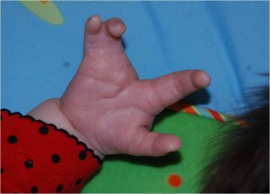 Olivia's cleft hand before surgery