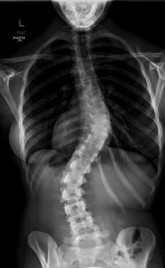 Scoliosis Patient X-ray