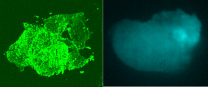 Pathology image (left) of Hunter's tumor glowing with BLZ-100 Tumor Paint and image of how Dr. Lee saw the tumor glow in the operating room (right). 