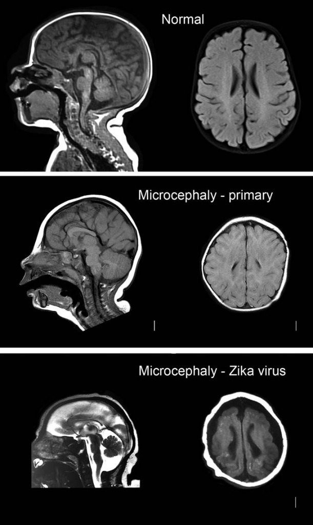 This image compares the brain of a baby that has developed normally (top), the brain of a baby that has developed primary microcephaly (middle), and the brain of a baby from Brazil whose mother contracted Zika virus during her pregnancy (bottom). The bottom image indicates several abnormalities, including a severe reduction in brain size, excess fluid around the brain (external hydrocephalus) and calcifications in the brain tissue that indicate abnormal brain development. IMAGE CREDIT: Dr. Lavinia Schuler-Faccini, Genetics Department, Federal University in Porto Alegre, Brazil.