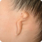 Microtia, an ear abnormality